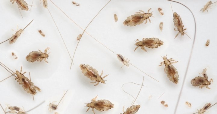 ‘Super lice’ are becoming more resistant to chemical shampoos. What to use instead