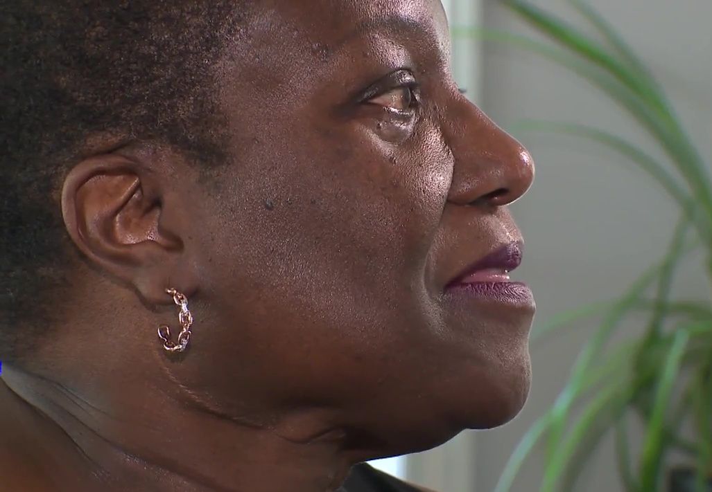 Brenda Frederick's face, 23 years after having extensive surgery to remove osteosarcoma bone cancer and undergoing treatment at Edmonton's Institute for Reconstructive Sciences in Medicine.