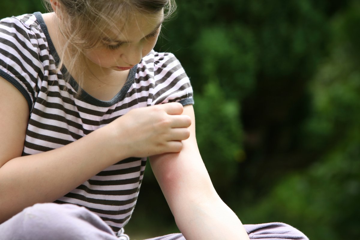 girl scratching mosquito bite