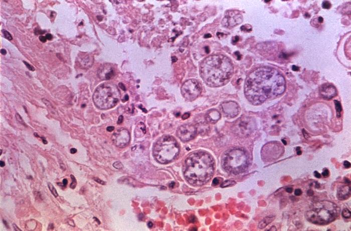 Under a magnification of a hematoxylin-eosin-stained tissue section, revealed histopathologic changes associated with a case of coccidioidomycosis, also known as valley fever. In this view, a number of sporangia could be seen inside the confines of a lymph node.