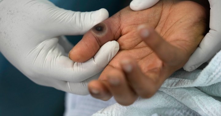 Тъй като броят на случаите на mpox ескалира в Африка