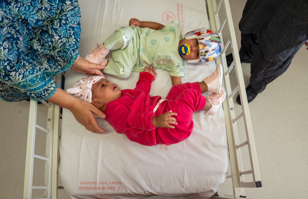 Mirha and Minal, Pakistani twins born conjoined at the head, are seen during their healing process after surgery at Bilkent City Hospital in Ankara, Turkey on September 06, 2024.