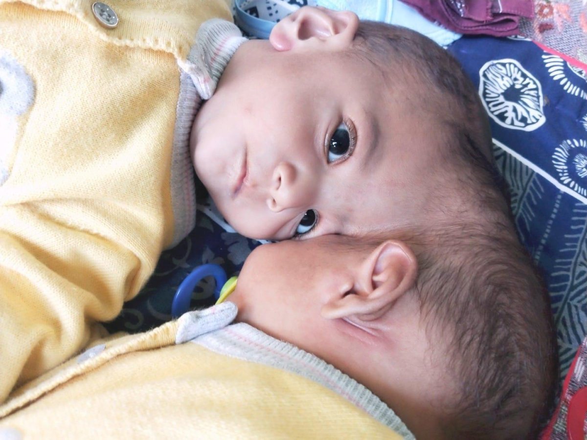 Mirha and Minal, Pakistani twins born conjoined at the head, are seen before their surgery.