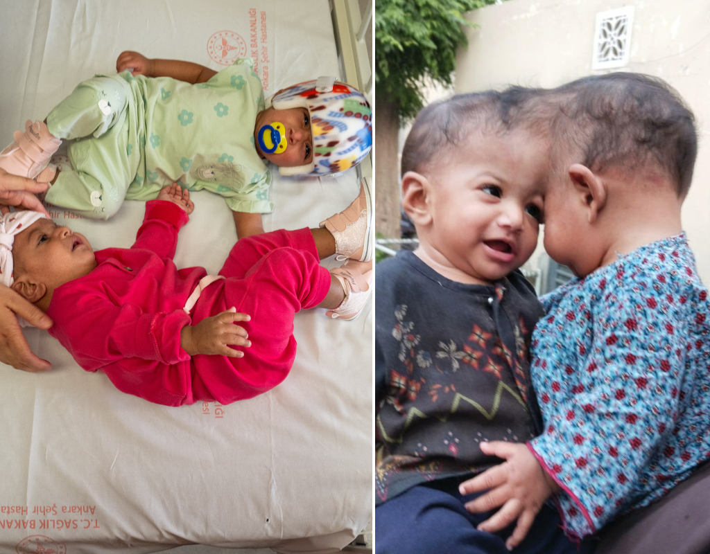 Twins conjoined at the head separated in marathon 14-hour surgery