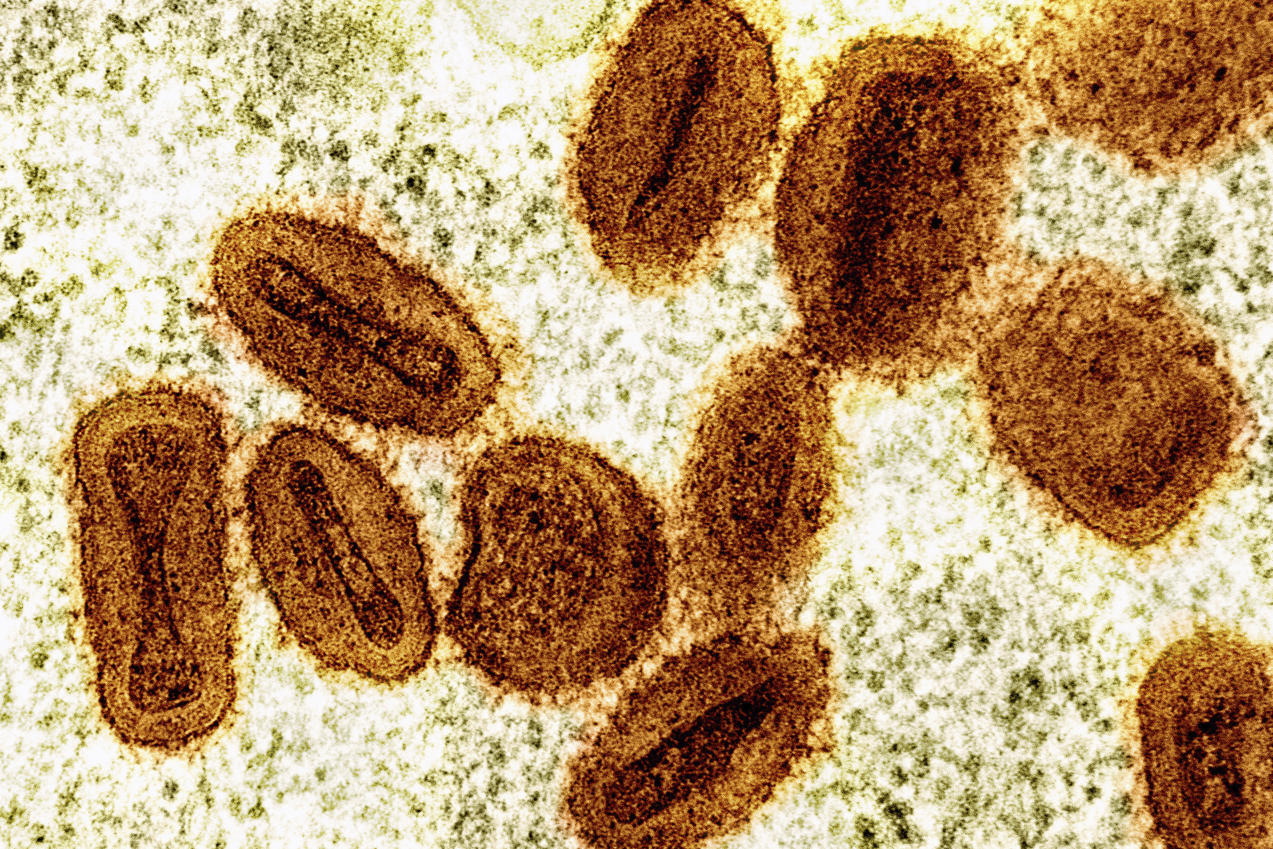 India reports 1st case of fast-spreading mpox strain