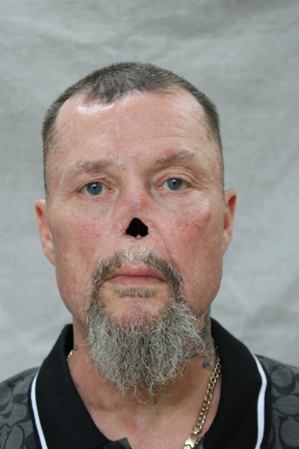 A man with a grey goatee wearing a black collared shirt is missing his nose.