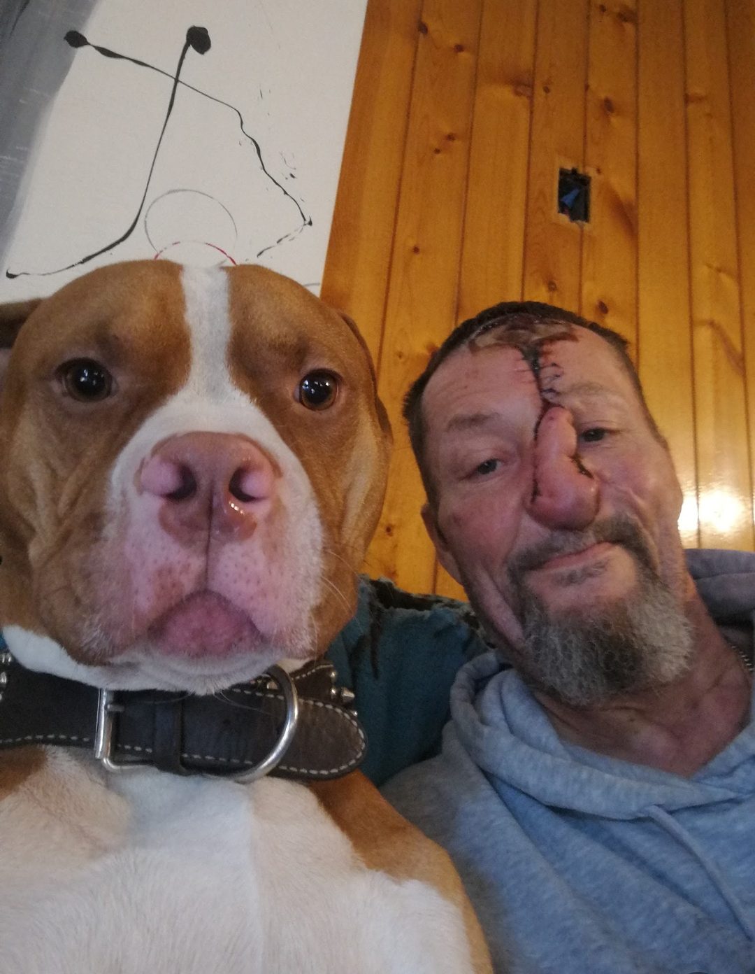 A man with a scar on his face and a badly swollen nose sits with a pitbull type dog