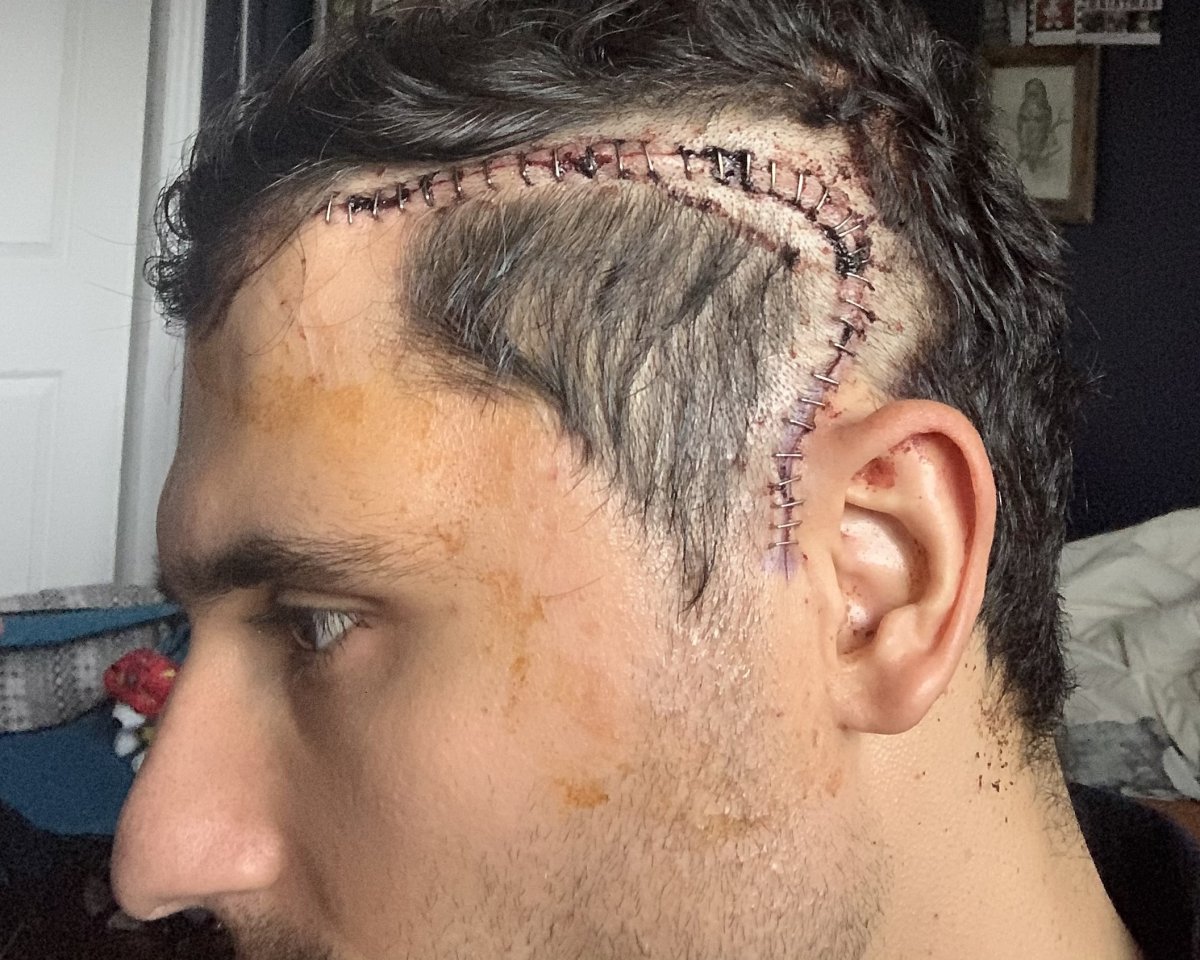 Steven Stefanidis after his brain surgery.