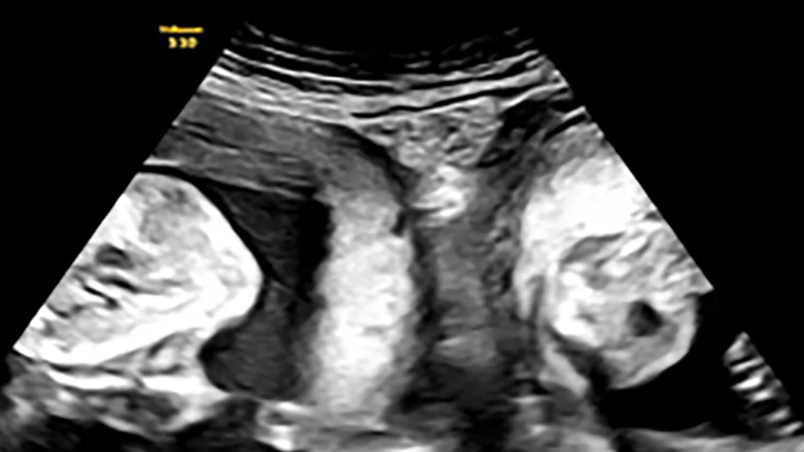 An ultrasound photo. There are two fetuses, in two separate wombs.