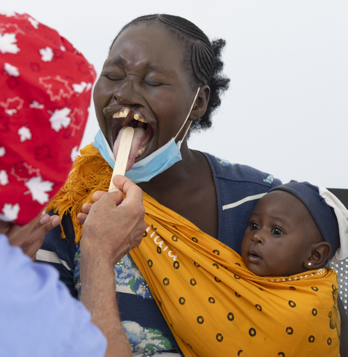 Zawadi Maringa before surgery to repair her cleft lip.