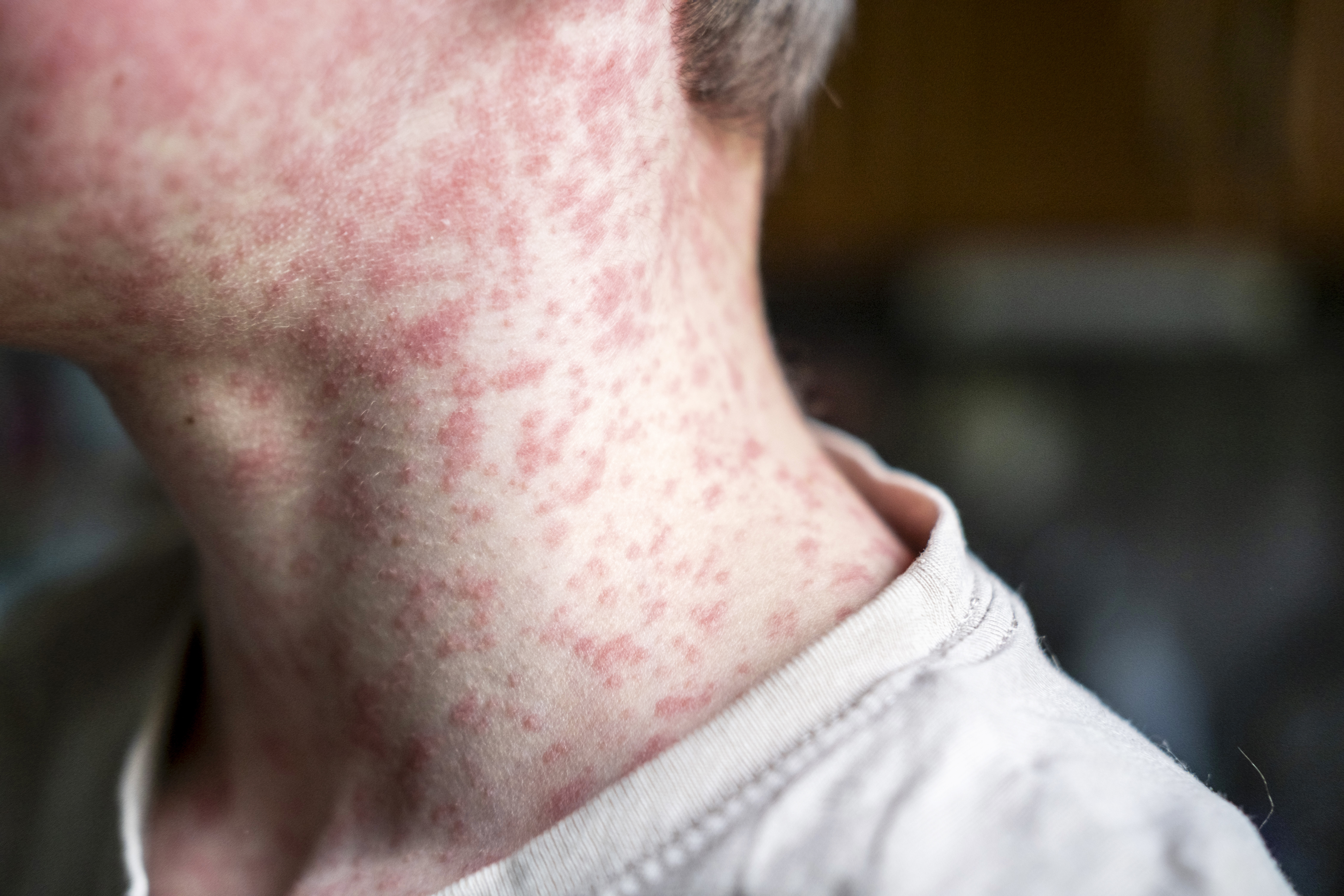 Ontario sees another sharp increase in measles cases over a week