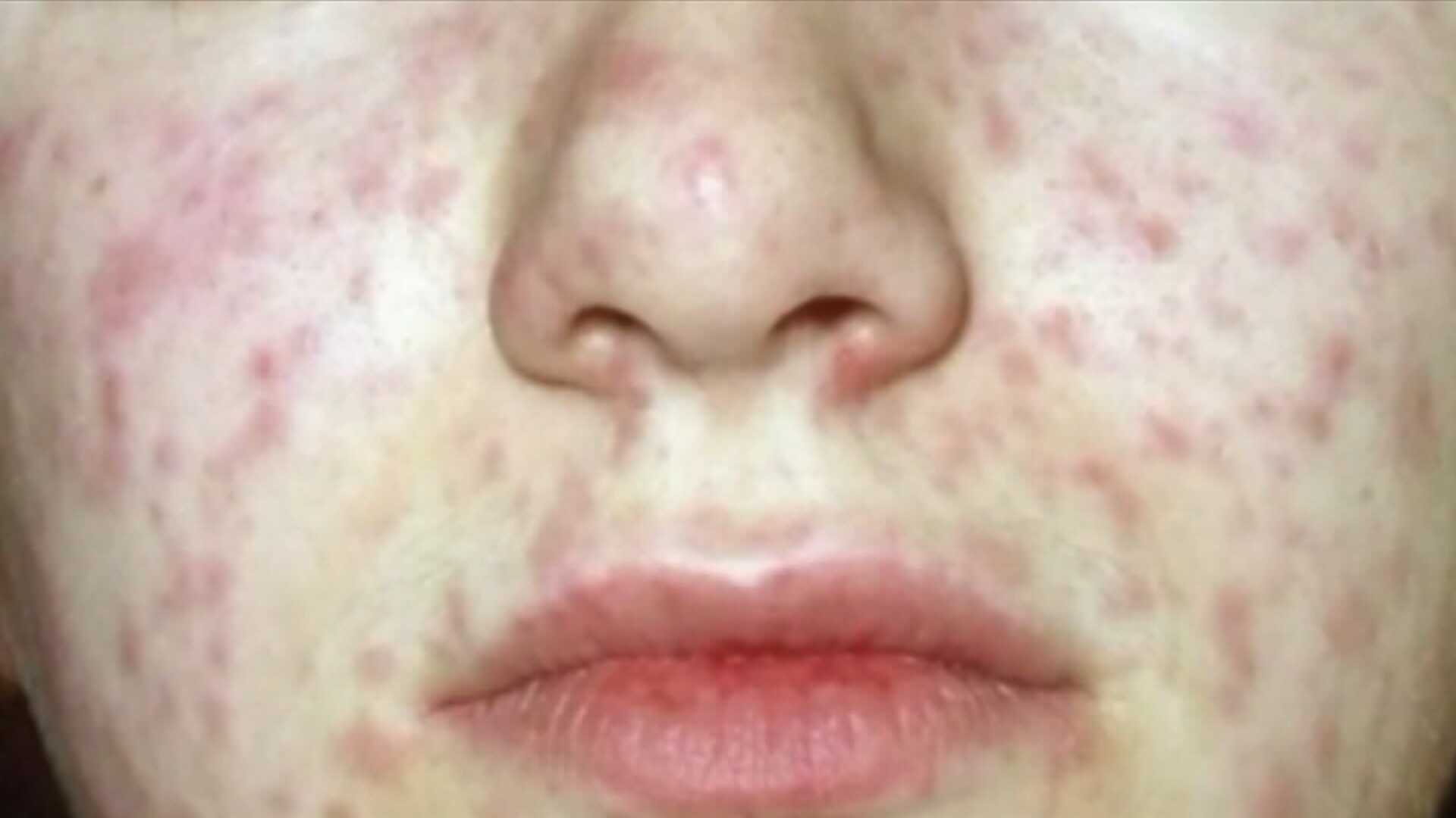 С броя на случаите на морбили в Алберта във възход