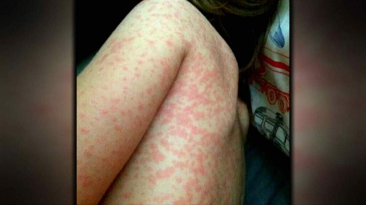 Measels is a very contagious and potentially deadly virus that health experts say can easily prevented by getting vaccinated.