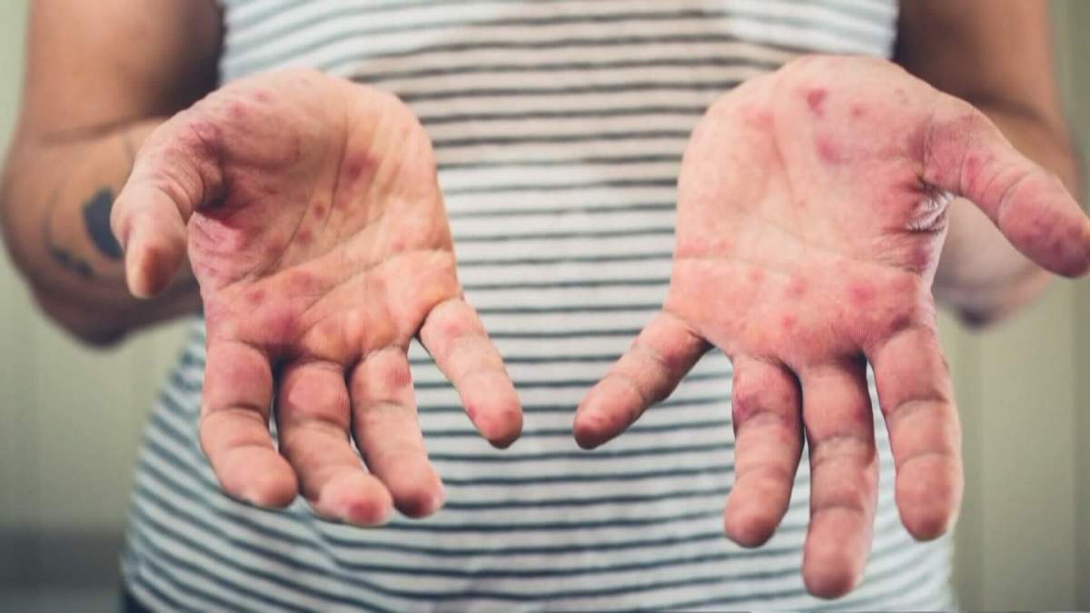 A child's hands, covered with red measles spots.