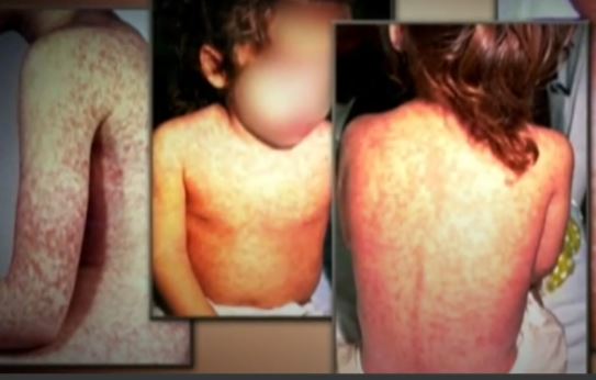 The symptoms of mesles include a fever of 38.3 C or higher, a cough, runny nose, red eyes and a rash that appears 3 to 7 days after the fever starts, usually beginning behind the ears and spreading down the body to the arms and legs.