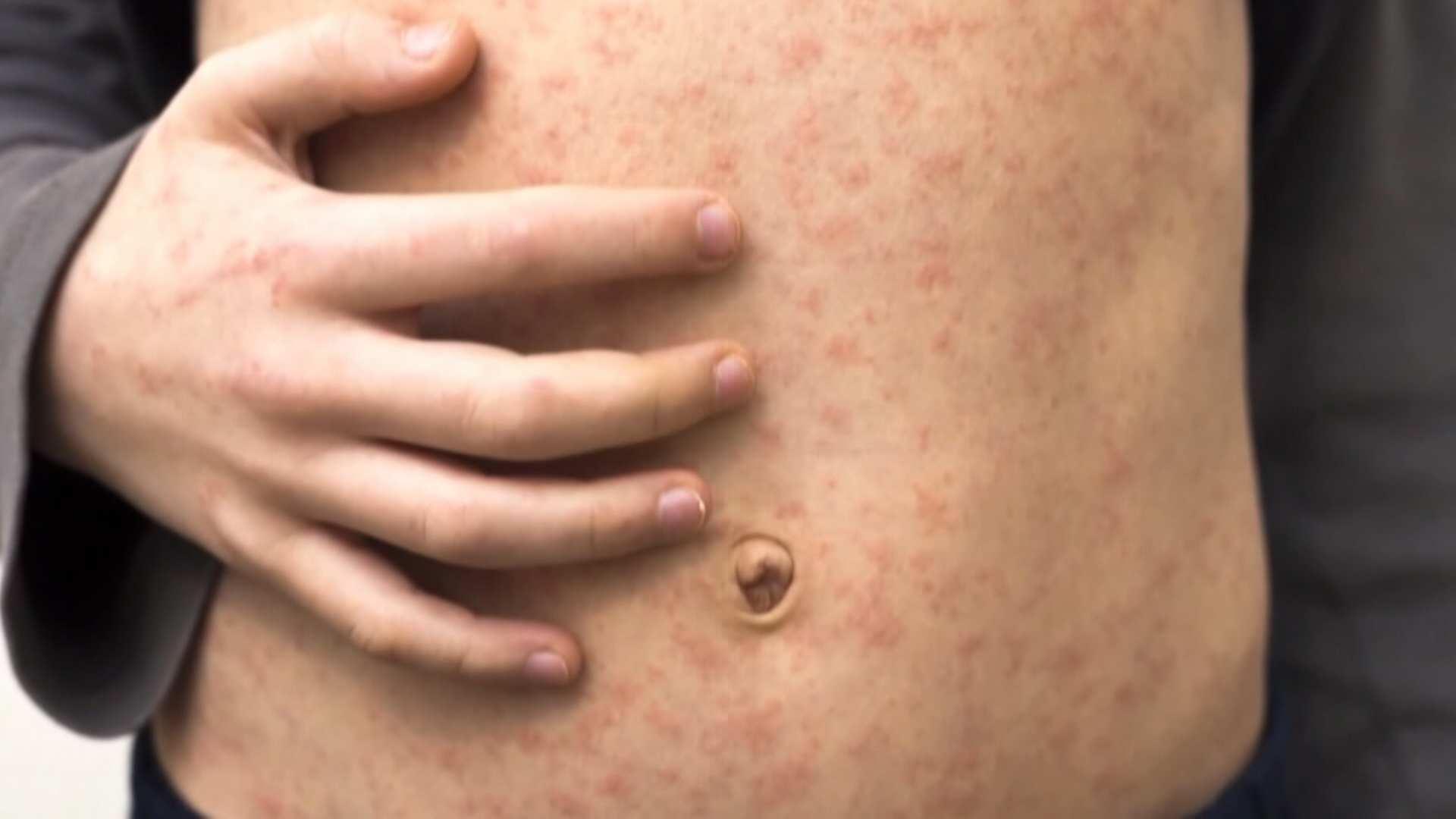 Броят на случаите на морбили в Алберта е взел още