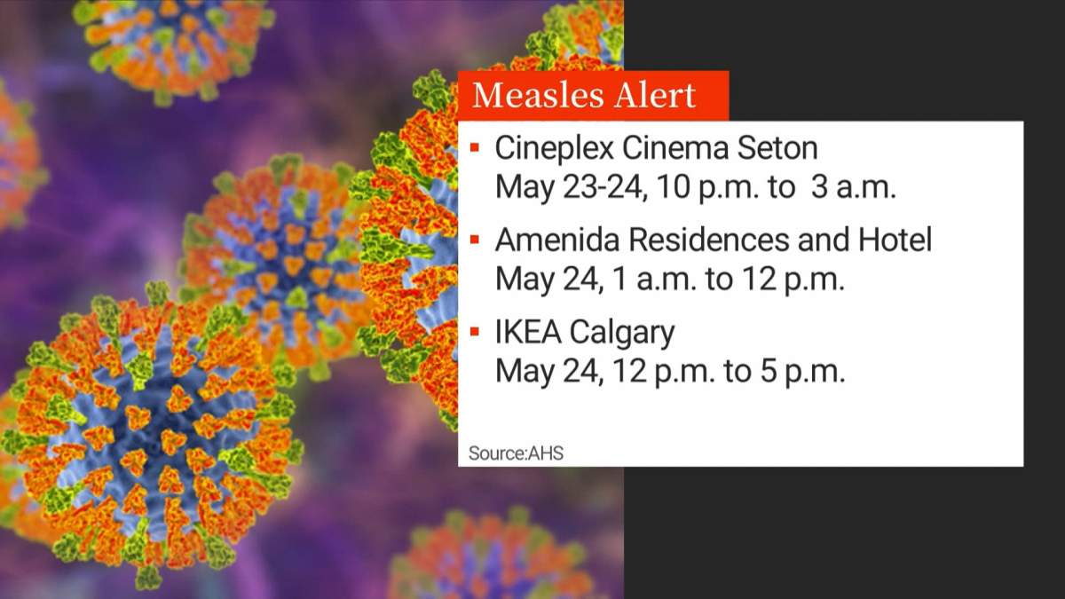 AHS said the person with the confirmed case of measles visited 3 high traffic locations in Calgary and is warning anyone who was in the area at the same time could be at risk of developing measles.