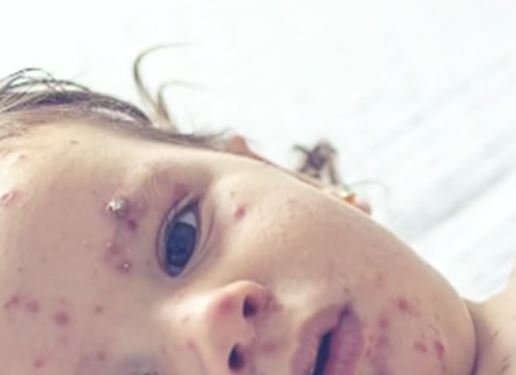 Алберта потвърди още 48 случая на морбили довеждайки общия брой