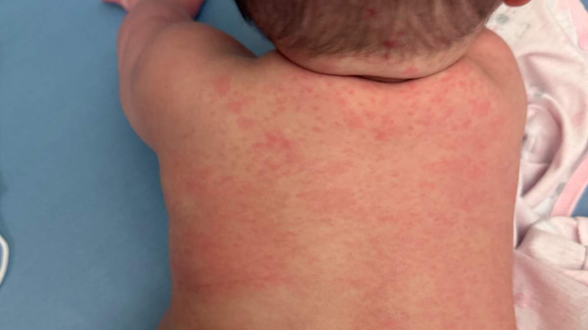 Kimie Fukuta-Birch was just four months old when she was diagnosed with measles in spring of 2025.