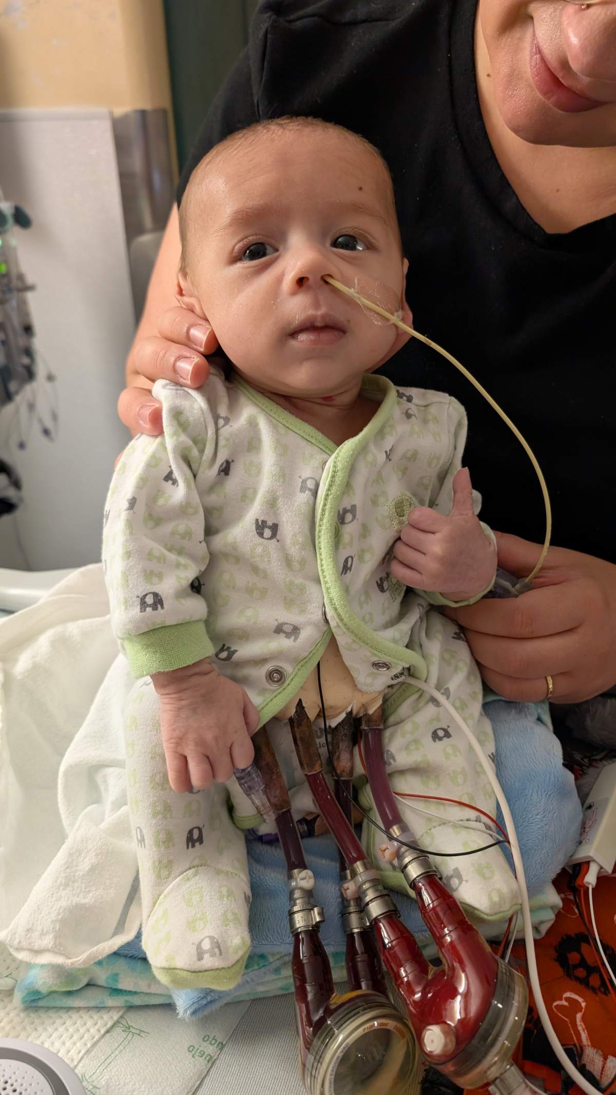 Baby with Ventricular Assist Device, a mechanical pump used to support heart function.