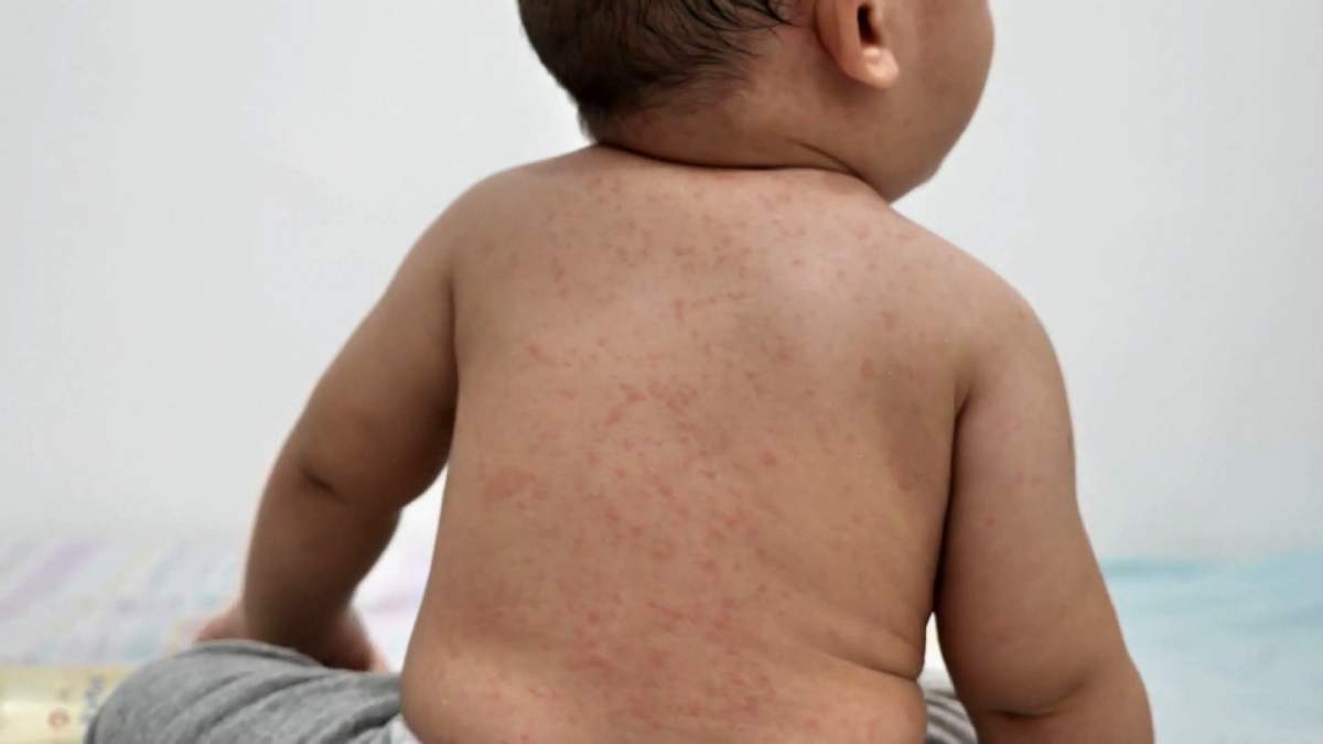 The total number of confirmed cases of measles in Alberta jumped to 1,454 over the weekend, well ahead of the entire United States, where there were 1,309 confirmed cases as of mid-July.