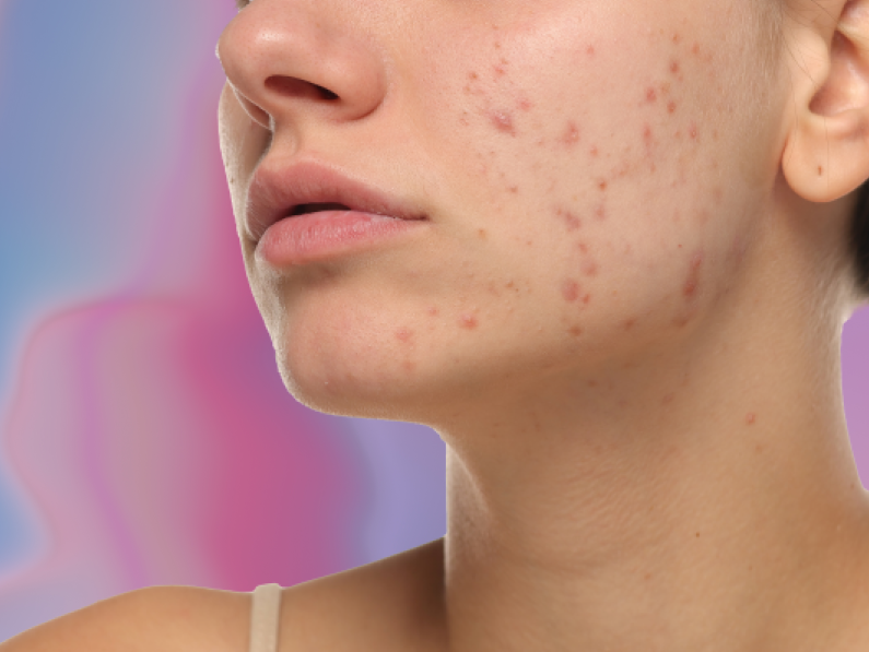 back-to-school acne
