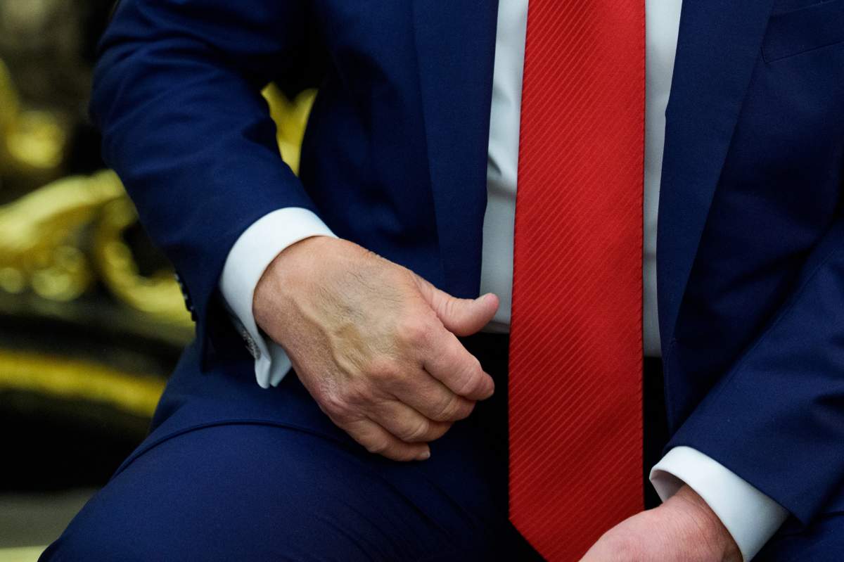 A bruise is visible on the hand of United States President Donald J Trump as he gives remarks during a bilateral meeting in the Oval Office of the White House in Washington, DC, USA, on Wednesday, September 3, 2025.