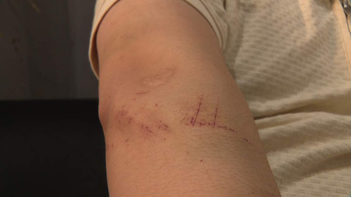 Jason Nguyen shows off some of the scratches and bruises he still has from the fight that took place when the two people who said they wanted to buy his laptop ended up pepper spraying and beating him in his own home.