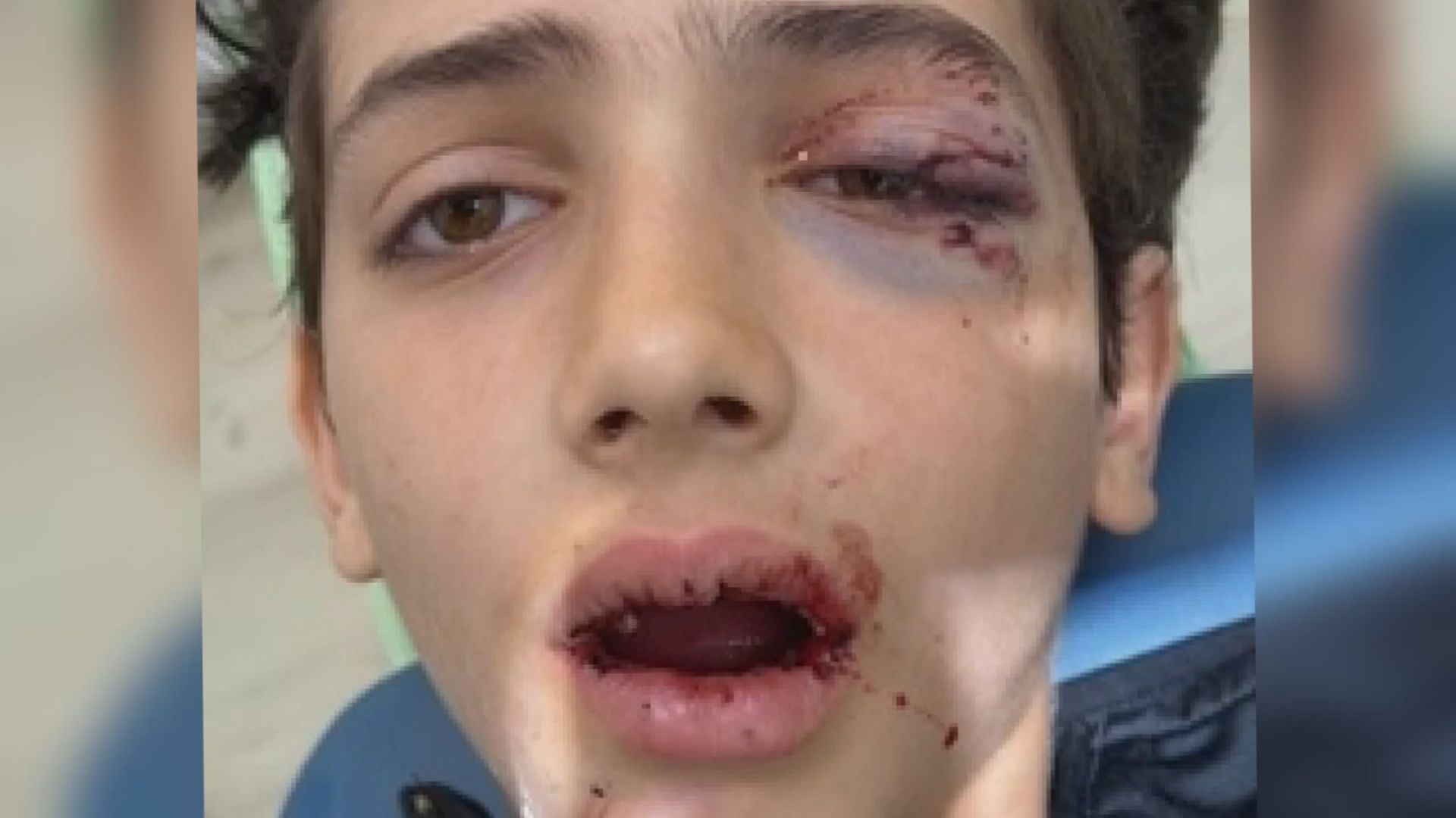 B.C. boy badly injured by child riding e-scooter on school grounds