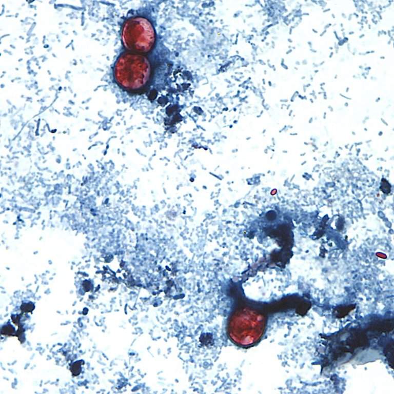 Where cyclosporiasis cases stand in Canada as U.S. parasite outbreak rages