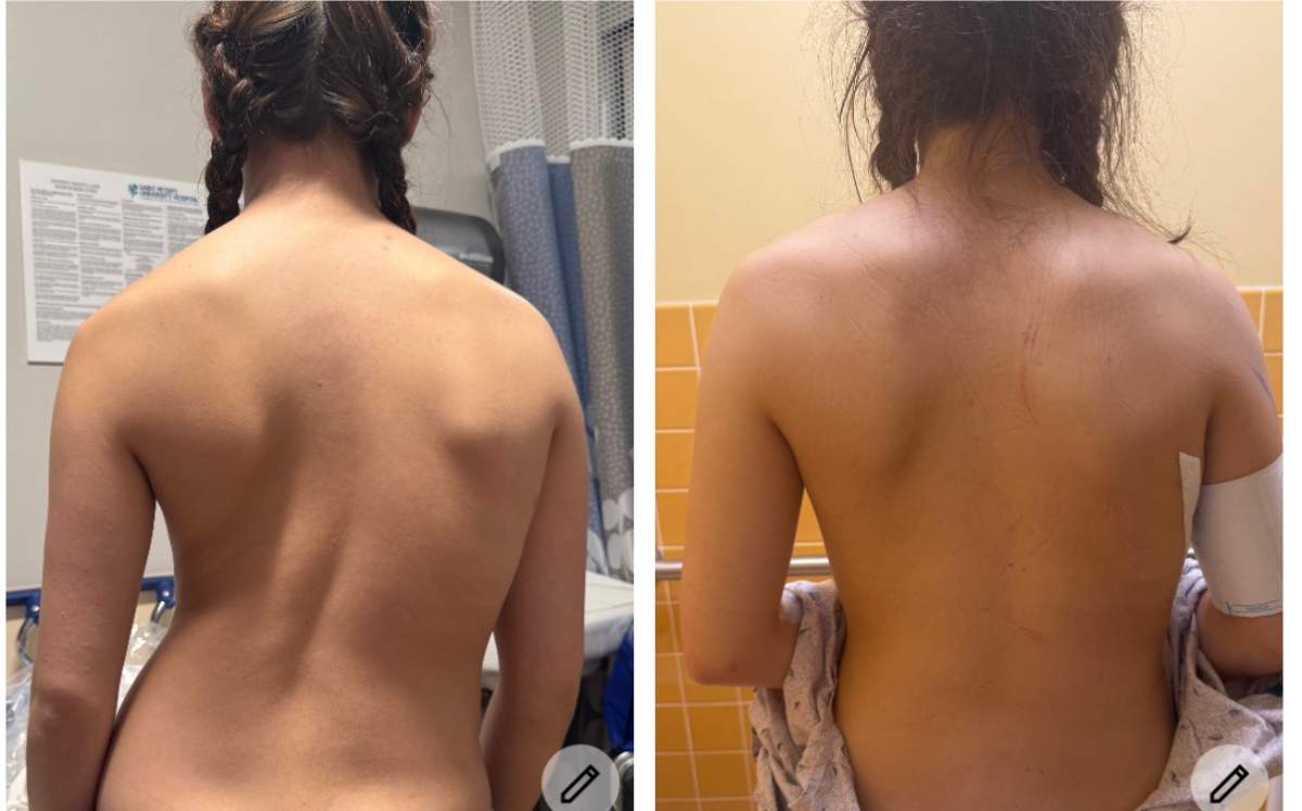Vienna’s spine before and after surgery in the United States.