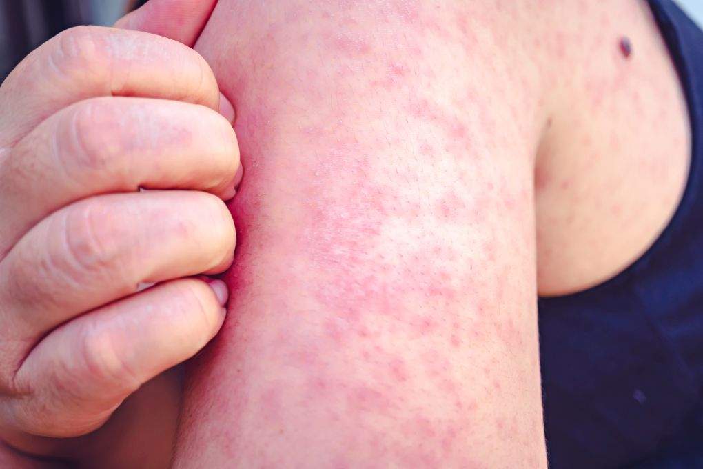 Manitoba declares measles outbreak over after weeks without cases